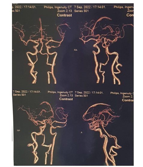 Figure 2: No aneurysm on CT angiography.