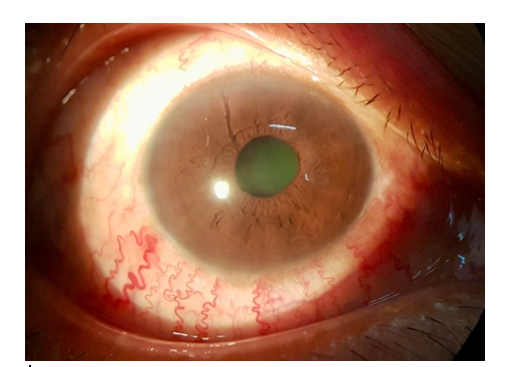 Figure 3: Cockscrew conjunctival vessels (right eye).