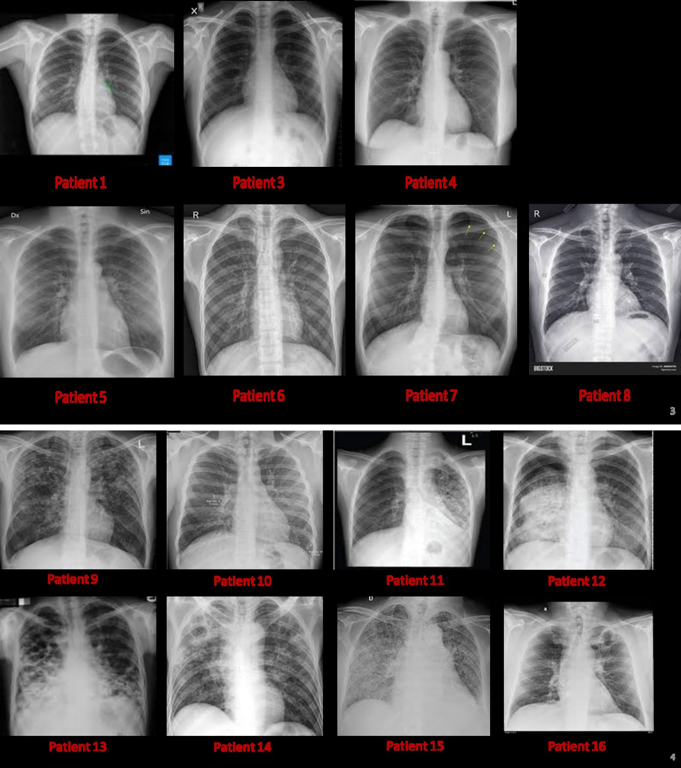 Figure 3: Chest X-ray images of TB infected patients showing varied lung infection status and conditions. Data indicate that TB infection of lung is multi-faceted and may need an all-round approach in clinical treatment and disease management.