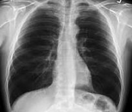 Figure 4: Patient 2 (TB infected lung).