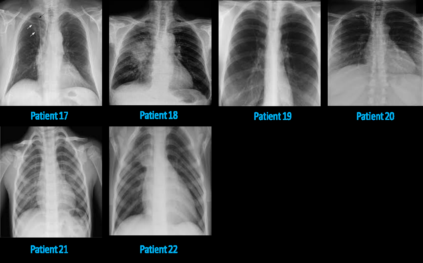 Figure 5: Chest X-ray images of latent TB lung patients showing clinically severe disease that does not correlate with the “latent” nature of the disease. Specifically, small white nodules can be seen dispersed throughout the lung volume in the left and right lung. More importantly, there is heart hypertrophy in many patients likely due to increased exertion of the heart to supply more blood to the deficient lung for gas exchange.