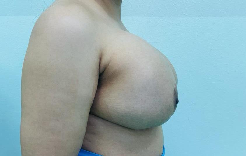 Figure 1: A 39-year-old female presented with bilateral breast enlargement and pain.