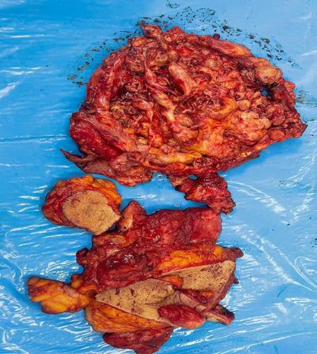 Figure 4: Bilateral breast specimen after inferior pedicle mammoplasty and removal of the silicone masses.