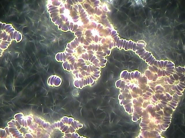 Figure 3: Unhealthy blood from male, 65, showing blood congestion and Clotting.