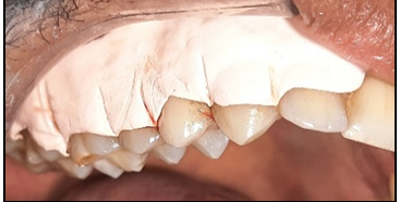 Figure 5: Periodontal Pack.