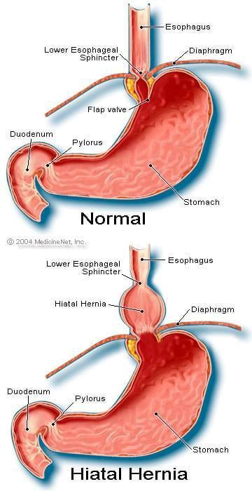 Figure 2: Hiral Hernia.