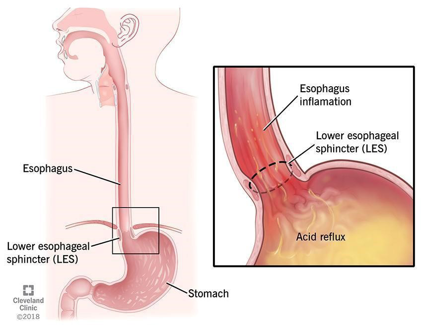 Figure 3: Showing Gastroesophageal Reflux Disease.