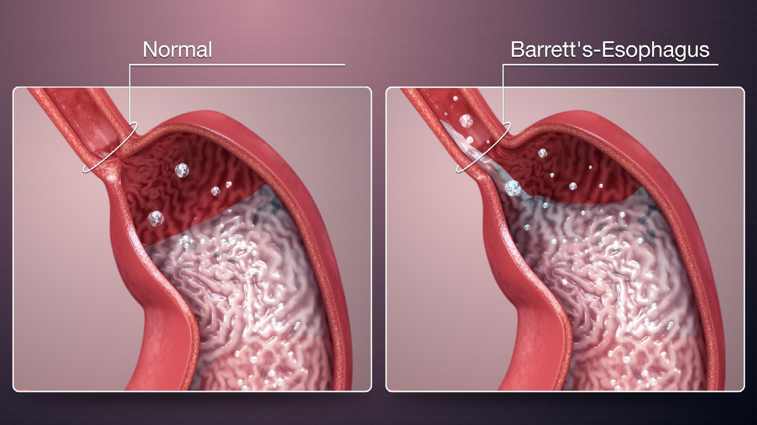 Figure 4: Barrett’s Esophagus Explained Shown Using Medical Animation Still Shot.