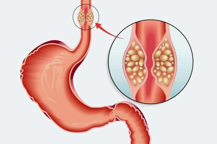 Figure 5: Esophageal (Food-Pipe) Cancer.