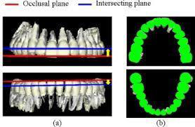 Figure 4: Shows Occlusal Plane & Intersecting Plane.