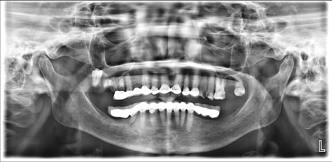 Figure 1: A Cone Beam Computed Tomography provided a detailed analysis Figure 2. The specialist and AI tools (ChatGPT versions 3 and 4) were given all available data, including history, clinical examination, and radiographic findings, to formulate a diagnosis and treatment plan for this unusual case of an impacted third molar [10].
