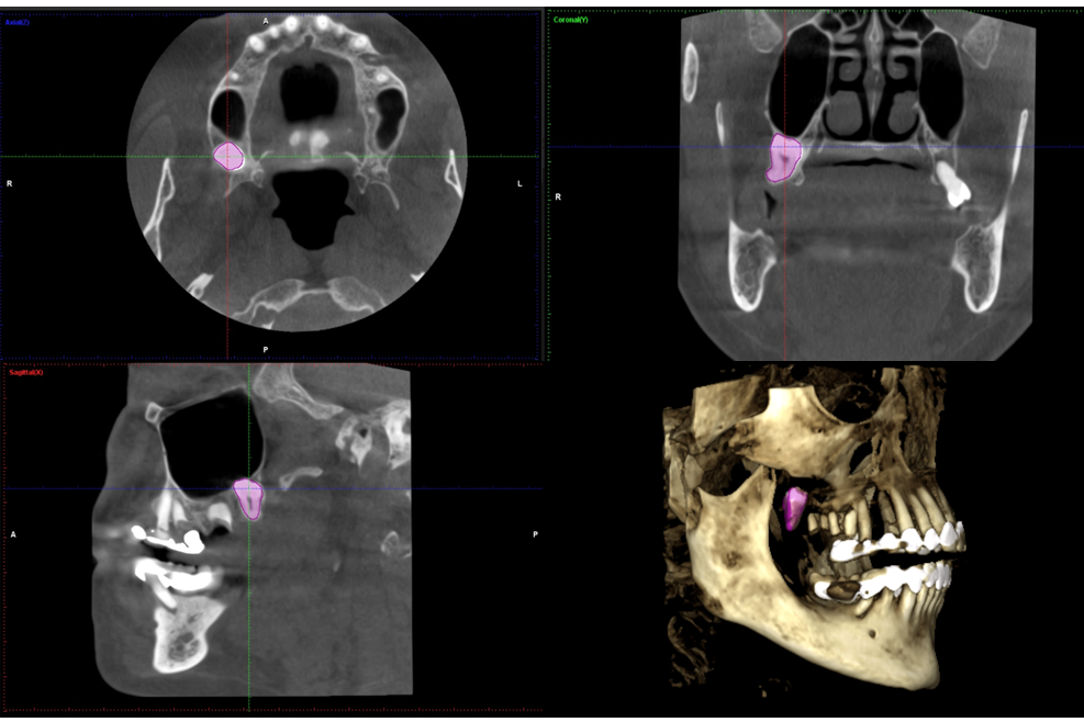 Figure 2: CBCT showing the inverted impacted third molar.