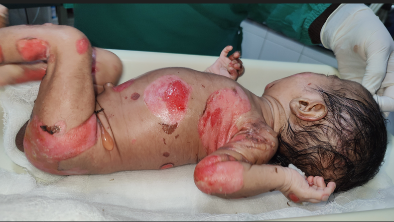Figure 2: Clear fluid filled bullae on an erythematous base over bilateral upper limbs.