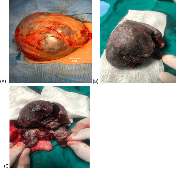 Figure 4: Images (A-C) show the pre-excised mass in its membranous sac and the post-excision mass, revealing an incompletely formed fetus with a rudimentary head, a well-developed spine, and both upper and lower limbs with fingers and toes.