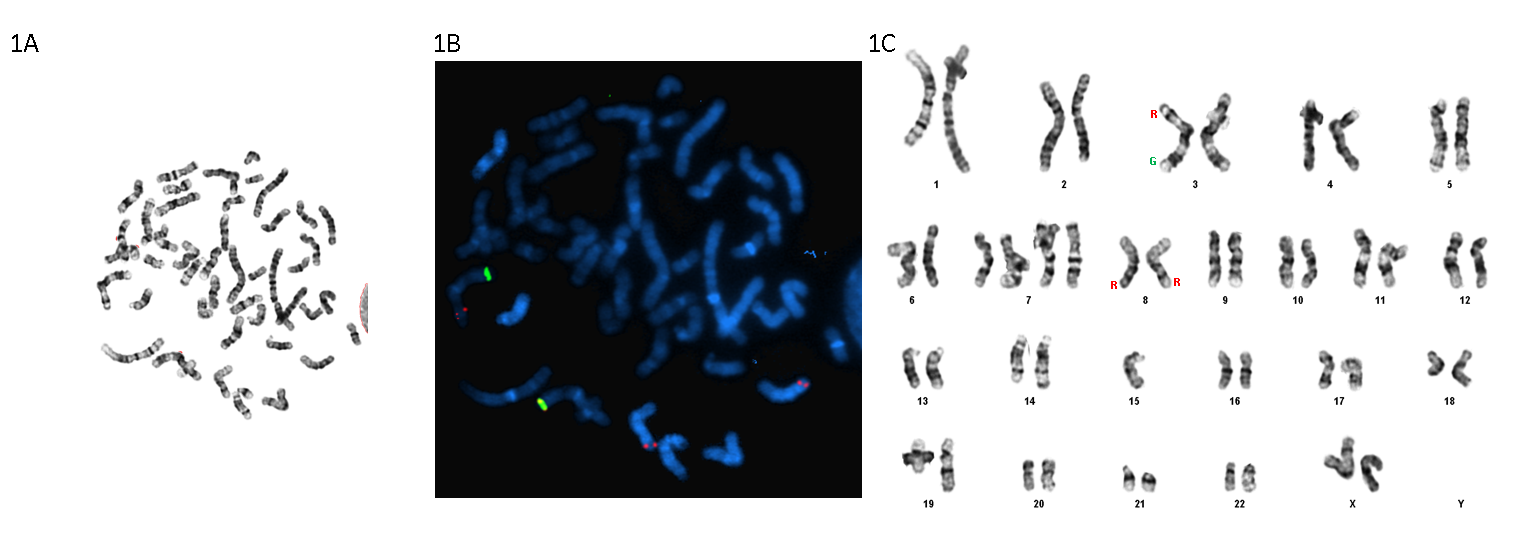 Figure 2: Showing BCL6 (3q27) Break Apart Probe FISH Signal Translocation to Chromosome 8 Long Arm (Tel 5’BCL6 Red [R]; Cen 3’BCL6 Green [G]). A. G-band metaphase; B. Reverse G-band Metaphase; C. Karyogram with Representation of the BCL6 Rearranged Signals.