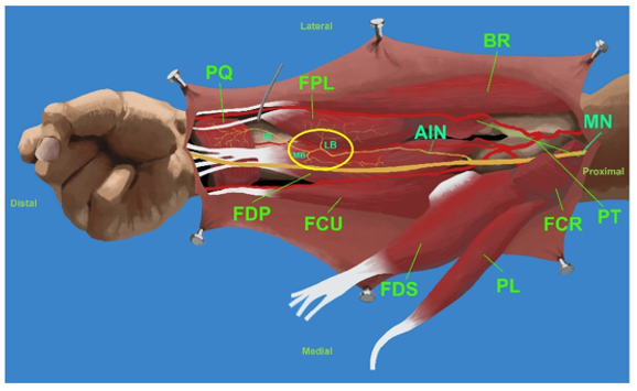 Figure 5: Type III: emission of the branch to the FPL and formation of a common trunk for the PQ and FDP branches. AIN = Anterior Interosseous Nerve; MN = Median Nerve; MB = Medial Branch to the FDP; IB = Intermediate Branch for PQ; LB = Lateral Branch to the FPL; PQ = Pronator Quadratus; FPL = Flexor Pollicis Longus; FDP = Flexor Digitorum Profundus; FCU = Flexor Carpi Ulnaris; FDS = Flexor Digitorum Superficialis; PL = Palmaris Longus; FCR = Flexor Carpi Radialis; PT = Pronator Teres; BR = Brachioradialis.