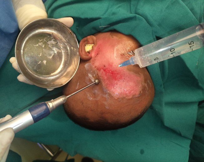 Figure 3: Dermabrasion and harvest of non-cultured keratinocyte graft.