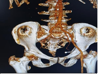 Figure 2: CECT Angiography of bilateral lower limbs and abdominal aorta showing blockade of right external iliac artery just distal to right CIA bifurcation on 3D CT.
