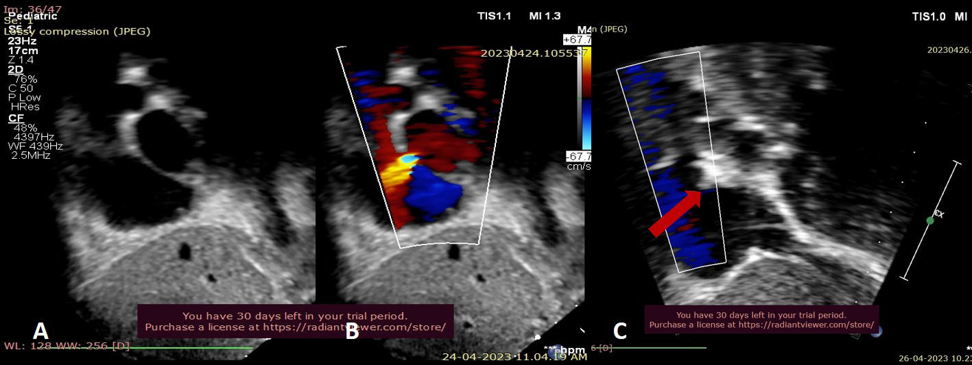 Figure 1: (A): 2D Echocardiogram done in subcoastal bi-caval view with colour interrogation; (B): showing small Atrial Septal defect shunting from left atrium to right atrium; (C): Subcoastal view in the same child after device closure showing device in situ and no residual shunt (red arrow).