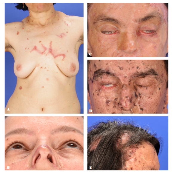 Figure 1: (A) Hypertrophic scar with complaint of psychosocial impact; (B) Nasal valves incompetence; (C-D) Periorbital region with insufficient inferior eyelid and lagophthalmos; (E) Alopecia.