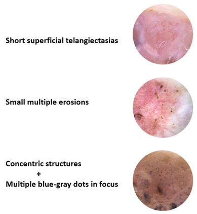 Figure 2: Different types and locations of lesions in Gorlin's patients. (A) Cervical, mental and nasal BCC; (B) Multiple lesions on face; (C) Eyelid lesion.