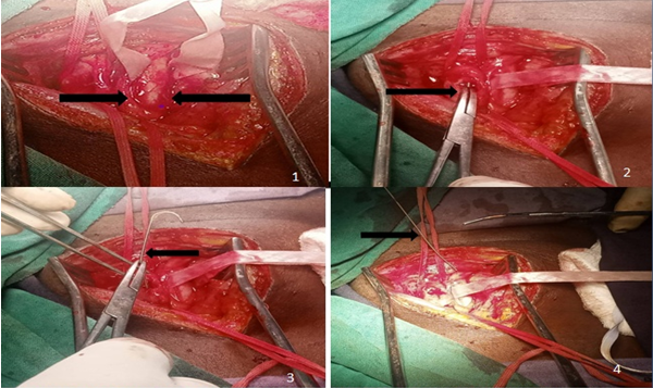 Figure 2: Migrated Guide Ware Extraction 1: Right neck exploration and isolation of internal jugular vein, 2.Transverse Venotomy Exposing the tip of guide wire, 3 &4: Clamping and retrievral of the intact guidewire by traction.