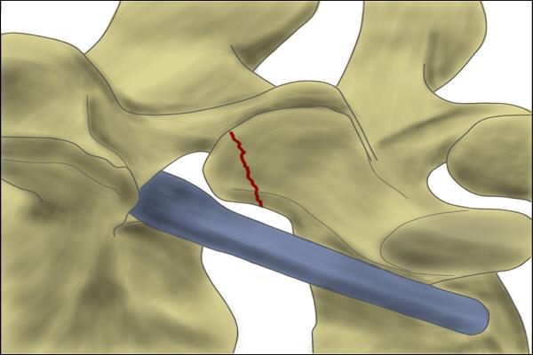 Figure 3: Curved instrument inserted to palpate the pedicle before osteotomy.