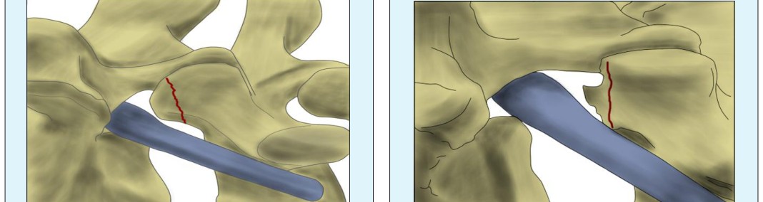 Figure 4: Osteotome performing the lumbar partial facetectomy.