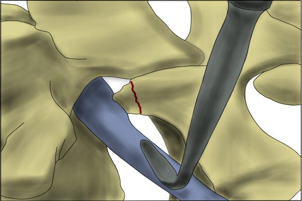 Figure 5: Neuroforamen after resection of bone.
