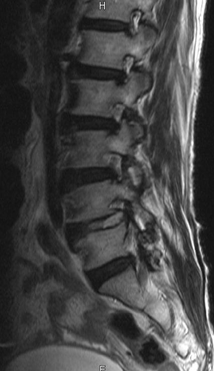 Figure 8: Preoperative and postoperative magnetic resonance imaging showing the removed disc material and decompressed nerve root.