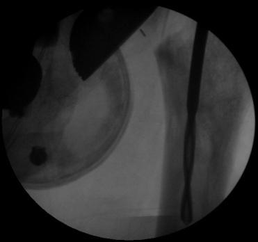 Figure 5: Post operative X ray.