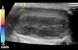 Figure 2: Gray-scale and color doppler images obtained through the left testicle in longitudinal acquisition demonstrate an oval hypoechoic lesion that shows increased vascularity on color doppler images.