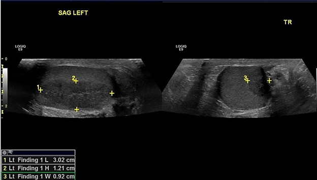 Figure 4: The right hypoechoic testicular lesion measuring 2.5 × 0.9 × 1.3 cm.