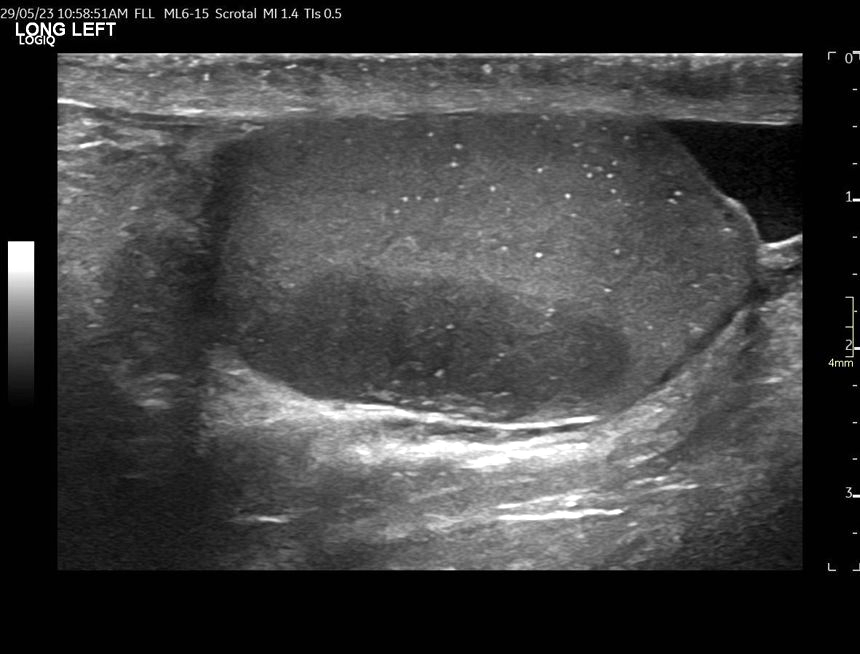 Figure 7: Similar changes of microlithiasis are also demonstrated on the right testicle.