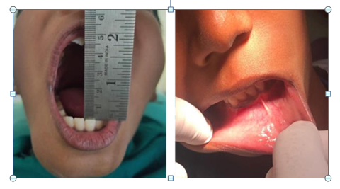 Figure 2: Intra Oral Images