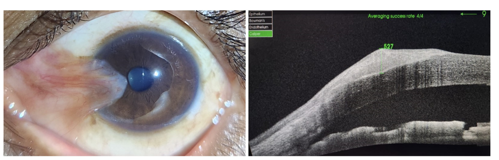 Figure 5: Shows Grade 3 nasal pterygium, corresponding AS-OCT scan, diameter 12 mm, of the same patient.