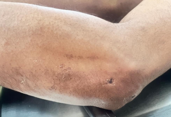 Figure 4: Superficial Abrasion on the Lateral Region of the Left Elbow.
