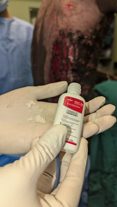 Figure 3: Use of Fibroheal powder over raw areas post thermal burns.