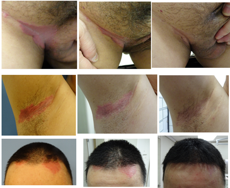 Figure 1: clinical photos showing the clinical progress on patient’s right groin, right underarm and frontal hairline. The photos on the left side were taken at week 0, middle at week 2, right side at week 4.