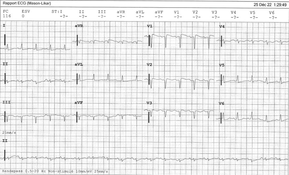 Figure 1: Baseline admission ECG.