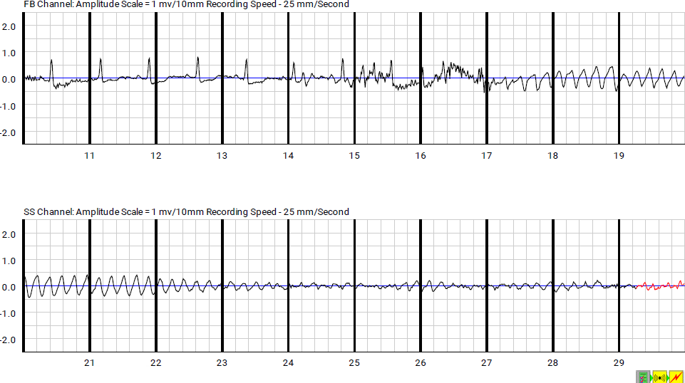 Figure 2: Beginning of VF at second 17 (Yellow arrow). The alarm starts at second 29 (Red Arrow).