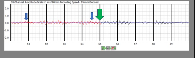 Figure 3: End of detection at second 55 without shock (Green arrow). Blue arrows indicate possible artefacts.