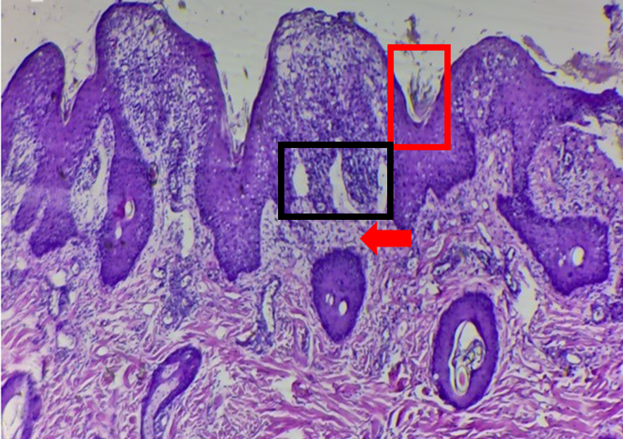 Figure 2: Histopathological analysis of nasal skin biopsy. Presence of hyperkeratosis and parakeratosis of stratum corneum and vacuolated basal layer (red square), with sharp separation of interphase (black square). Presence of inflammatory focus located in the dermis (red arrow) and edema of papillary plexus (Magnification 10X). Hematoxylin-Eosin (H&E) and Periodic Acid-Schiff (PAS) staining.