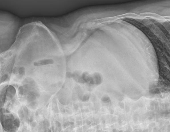 Figure 2: Abdominal X-ray (left lateral decubitus view).