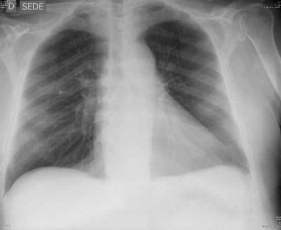 Figure 3: Chest X-ray (PA projection). Abdominal ultrasound showed nothing that would explain patient's clinical picture. It only showed an extensive bowel meteorism and liver steatosis and hemangioma. CT with contrast confirmed the liver hemangioma and spoke of inguinal hernia that was not causing any obstruction. Diverticula of colon and sigma were present. There was no air or fluid intraperitoneally (Figure 4).