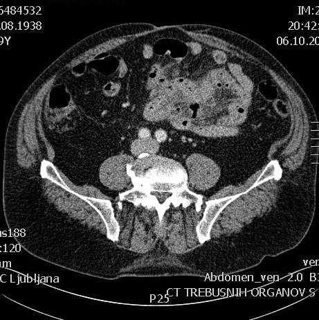 Figure 4: CT of the abdomen with contrast (transverse view). The patient was sent to the operating theater. He was placed in a supine position and endotracheally intubated. The operative field was prepared in a sterile manner. An explorative laparotomy was performed. An abscess as a consequence of perforated divertuculum of the jejunum had been discovered and evacuated. A sample of the abscess had been taken and a drain had been inserted into the abdominal cavity. An adhesiolysis of a few glued small bowel loops had also been performed. The laparotomy was sutured with interrupted resorbable sutures and the skin wound was closed with staples. Postoperative control CT of the abdomen confirmed that there were no signs of any abscess in the abdominal cavity but the diverticula of the jejunum were present. There were also some gas bubbles in the mesenteric fat that were suspicious for perforation. The patient needed a prolonged antibiotic therapy after the surgery due to the elevated inflammatory parameters that have been slowly decreasing. He had a prolonged postoperative bowel paresis that was managed conservatively with nasogastric suction, prokinetic agents and bowel enemas. The other postoperative course was uneventful.