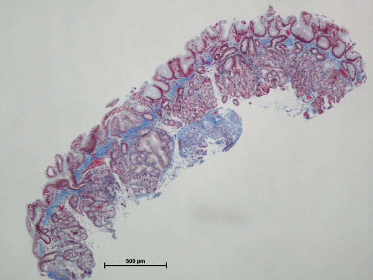 Figure 2: Thick subepithelial collagen involved both columnar (black arrow) and squamous (white arrow) components of GEJ.