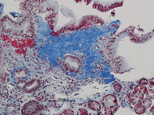 Figure 4: Focal detachment (left) and denudation (right) of columnar and squamous epithelial lining of GEJ.