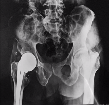 Figure 2: Femoral neck fracture treated by hemi- arthroplasty.