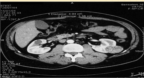 Figure 1: Renal CT scan performed during the initial assessment. Left renal mass 39x32mm with double component.